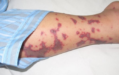 Ghi nhận ca mắc viêm não mô cầu đầu tiên tại Hà Nội