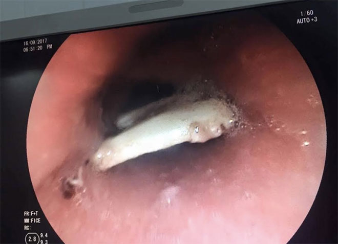 Miếng xương được gắp ra khỏi thực quản bệnh nh&acirc;n.