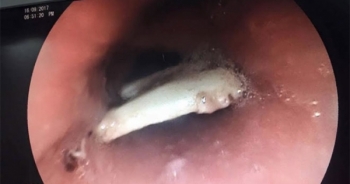 Gắp xương dài 2,5cm ra khỏi thực quản bệnh nhân