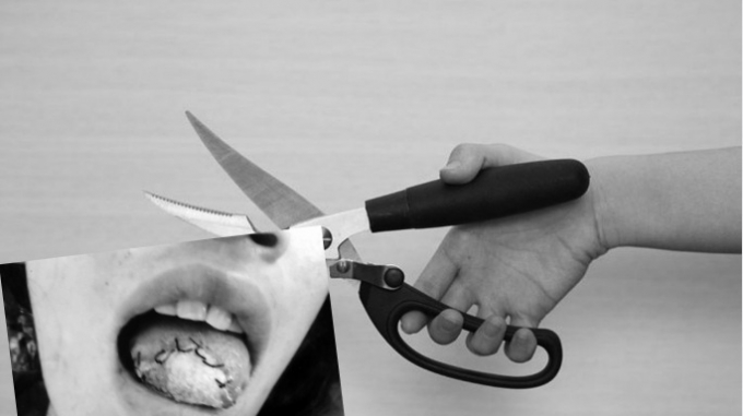 Phần lưỡi của chị Nở được nối nhưng cuối c&ugrave;ng phải vứt bỏ (Ảnh gia đ&igrave;nh cung cấp).