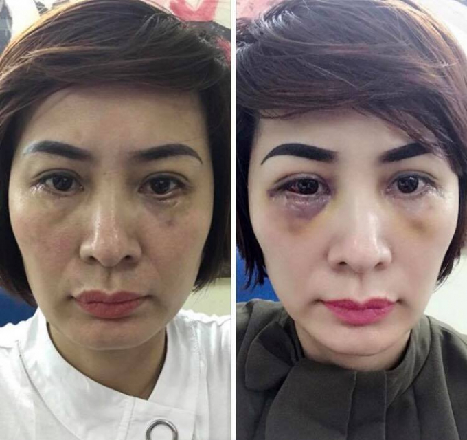 Mắt của chị Trần Lệ Th&uacute;y sau gần 1 th&aacute;ng cắt mỡ m&iacute; dưới tại Thẩm mỹ viện Lilia.