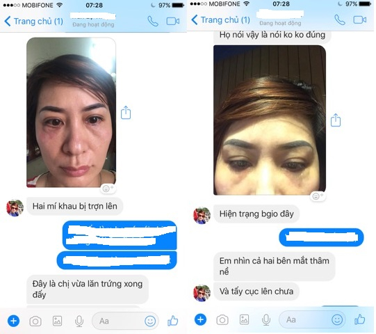 H&igrave;nh ảnh mắt chị Th&uacute;y chụp s&aacute;ng ng&agrave;y 15/9 vẫn sưng t&iacute;m v&agrave; tấy cục nhưng đại diện TMV Lilia vẫn khẳng định đ&atilde; b&igrave;nh thường.