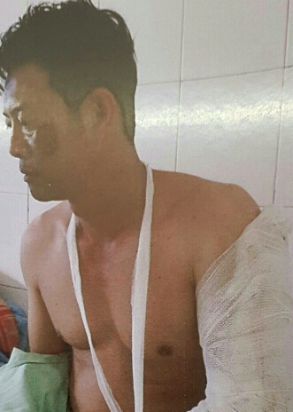 &Ocirc;ng Hậu bị ch&eacute;m gần đứt l&igrave;a c&aacute;nh tay.