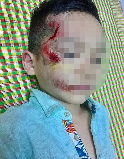 Ch&aacute;u b&eacute; bị thương t&iacute;ch tr&ecirc;n mặt (Nguồn Infornet).