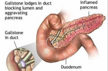 Uống rượu cấp tập 3 ngày liên tục, cán bộ hải quan tử vong vì viêm tuỵ cấp