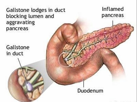 Uống rượu cấp tập 3 ng&agrave;y li&ecirc;n tục, c&aacute;n bộ hải quan tử vong v&igrave; vi&ecirc;m tuỵ cấp