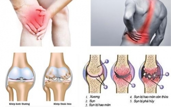 Bệnh viện Bạch Mai khám, tư vấn miễn phí bệnh cơ xương khớp