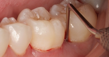 Suýt mất mạng vì ngộ độc thuốc tê khi nhổ răng