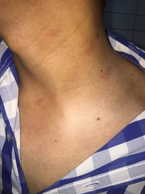 Vết t&iacute;ch tr&ecirc;n cổ Nh&agrave; b&aacute;o Trần Hiếu (nguồn ảnh b&aacute;o Phụ Nữ Việt Nam).