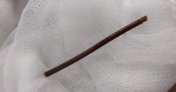 Cụ bà bị đâm thủng dạ dày vì... tăm xỉa răng