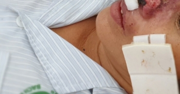 Nguy cơ tái bùng phát bệnh whitmore ăn cánh mũi