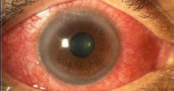 Triệu chứng căn bệnh nguy hiểm cướp đi ánh sáng người bệnh