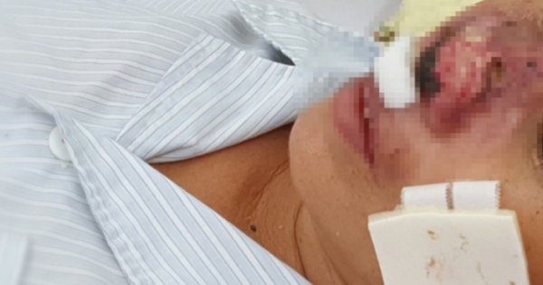 Vi khuẩn ăn thịt người Whitmore có thể gây tử vong trong vòng 48 tiếng