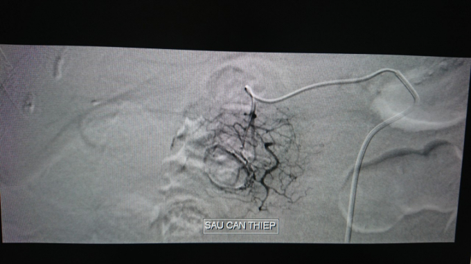 Sau can thiệp không còn thoát mạch