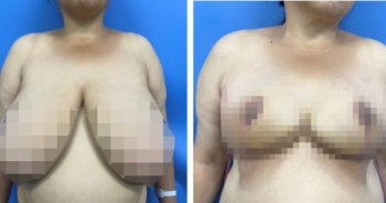 Bệnh viện Đại học Y Hà Nội phẫu thuật tái tạo vú phì đại khổng lồ hiếm gặp