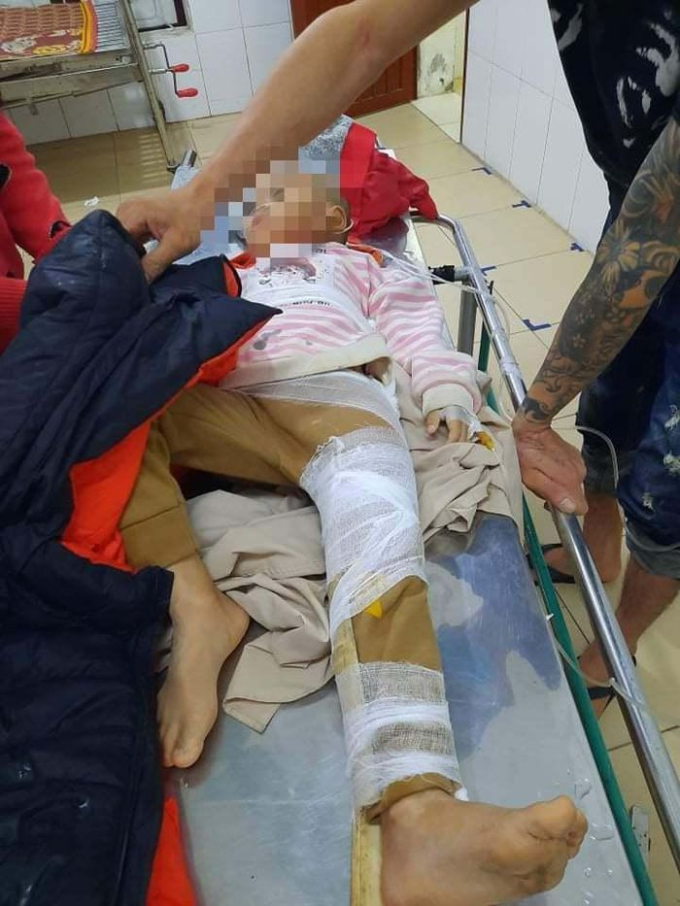 Cháu N.K.P (SN 2016) bị gãy xương đùi đang được cấp cứu tại bệnh viện.