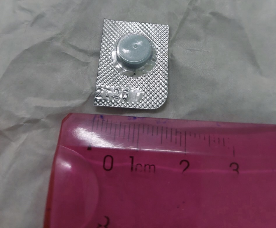 Dị vật được lấy ra khỏi thực quản của bệnh nhi.