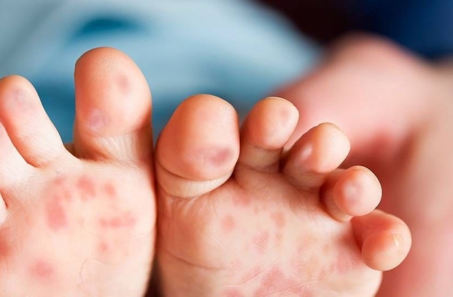 C&aacute;c giải ph&aacute;p ph&ograve;ng, chống bệnh tay ch&acirc;n miệng