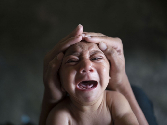 WHO cũng đ&atilde; khẳng định c&oacute; mối li&ecirc;n quan giữa virus Zika với chứng đầu nhỏ ở trẻ sơ sinh v&agrave; Hội chứng vi&ecirc;m đa rễ d&acirc;y thần kinh.