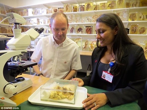 Quả tim c&oacute; k&iacute;ch thước gấp 3 lần quả tim của người thường khiến anh Kieran kh&ocirc;ng n&oacute;i th&agrave;nh lời.&nbsp;