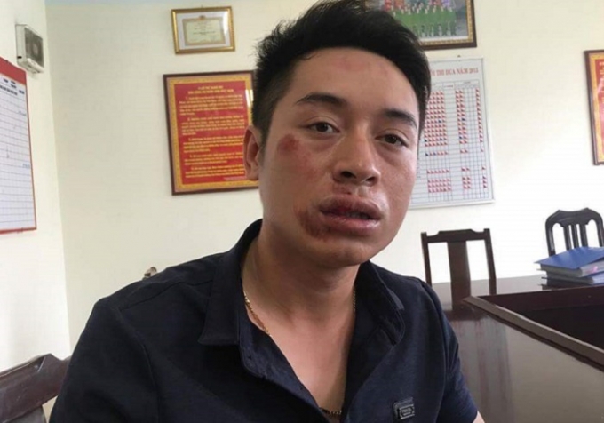 Mặt Trung &uacute;y T&ugrave;ng biến dạng sau khi bị đối tượng tấn c&ocirc;ng li&ecirc;n tiếp. Ảnh: D.H.