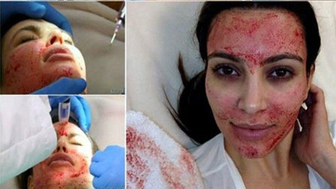 Phương ph&aacute;p l&agrave;m đẹp bằng m&aacute;u. Ảnh: Internet