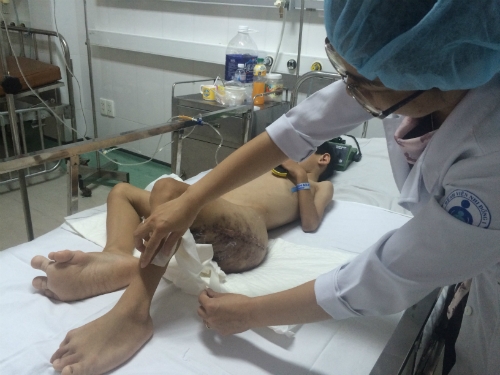 Hội chứng hiếm gặp khiến c&aacute;c đầu ng&oacute;n ch&acirc;n b&eacute;&nbsp;cũng to nhỏ bất thường. Ảnh:&nbsp;L&ecirc; Phương.