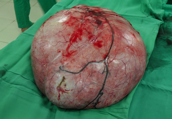 Khối u nặng 10kg được lấy ra từ bụng b&eacute; g&aacute;i 12 tuổi.