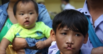 Phẫu thuật miễn phí cho trẻ em bị hở môi, hàm ếch tại khu vực phía Bắc