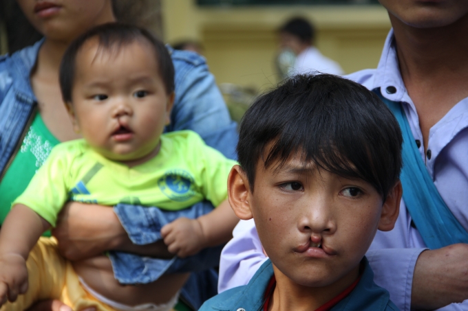 Dị tật hở m&ocirc;i, h&agrave;m ếch khiến trẻ gặp nhiều kh&oacute; khăn trong cuộc sống h&agrave;ng ng&agrave;y.