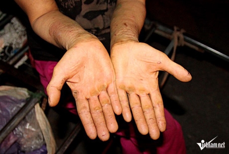 K&eacute;o xe li&ecirc;n tục xuy&ecirc;n đ&ecirc;m với những chuyến h&agrave;ng nặng khiến đ&ocirc;i b&agrave;n tay của c&aacute;c nữ cửu vạn chai sần với nhiều vết xước.