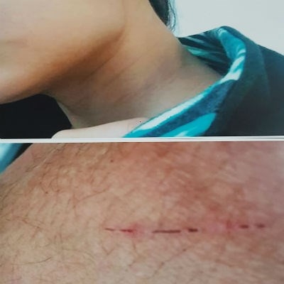 Những vết chấn thương bầm t&iacute;m tr&ecirc;n cổ, trầy xướt hằn dấu bị tấn c&ocirc;ng tr&ecirc;n người nạn nh&acirc;n. Ảnh do gia đ&igrave;nh nạn nh&acirc;n cung cấp.