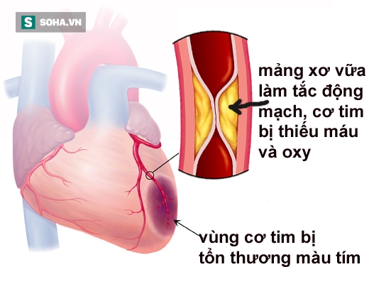 Bệnh nhồi m&aacute;u cơ tim: Những c&aacute;i chết kh&ocirc;ng được b&aacute;o trước