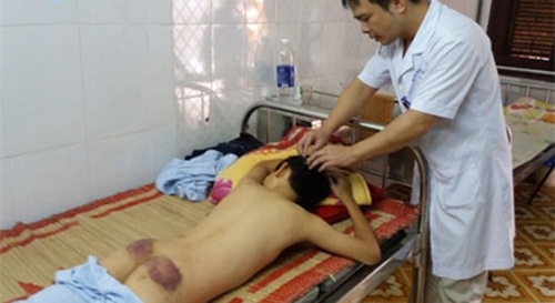 Lào Cai: Công an vào cuộc điều tra vụ bé trai bị bố và mẹ kế đánh bầm dập