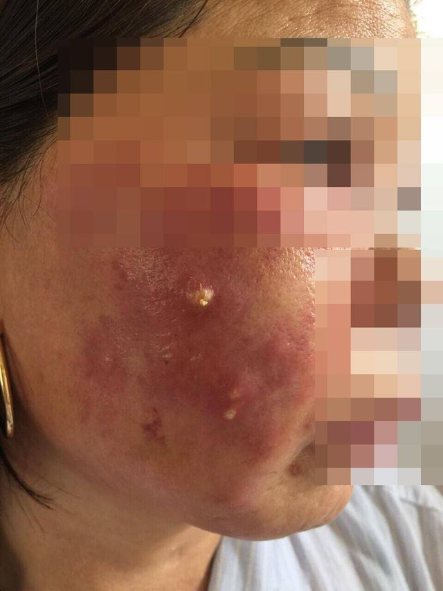 Bệnh nh&acirc;n đ&atilde; phải nhập viện v&igrave; biến chứng nhiễm tr&ugrave;ng da sau khi b&ocirc;i v&agrave; ti&ecirc;m thuốc trắng da.