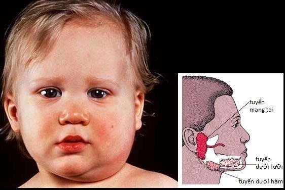 Sau khi bị bệnh, c&aacute;c tuyến mang tai gần tai của người bệnh bắt đầu sưng l&ecirc;n v&agrave; đau, l&agrave;m cho việc nhai v&agrave; nuốt đau đớn&hellip; Ảnh: Internet.