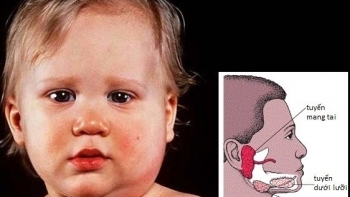 Cẩn trọng bệnh quai bị vào mùa