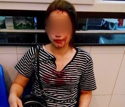 H&igrave;nh ảnh c&ocirc; g&aacute;i trẻ bị h&agrave;nh hung đăng tải tr&ecirc;n mạng x&atilde; hội. (ảnh FB H.L).