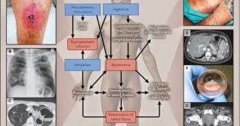89.000 người chết trên thế giới do bệnh truyền nhiễm nguy hiểm Melioidosis