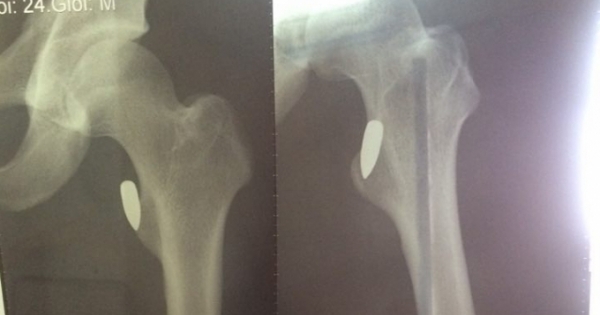 VĐV Pencaksilat  bị trúng đạn khi đang đi trên đường