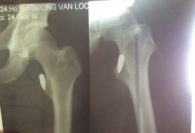 Vi&ecirc;n đạn nằm ở vị tr&iacute; rất s&acirc;u, gần xương.&nbsp;
