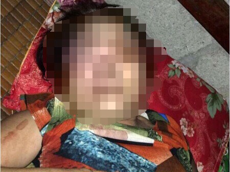 Nạn nh&acirc;n bị đ&aacute;nh m&ugrave; mắt.