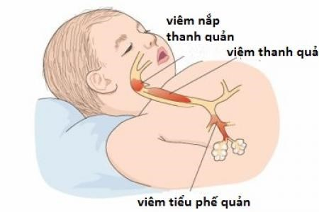 Trẻ dưới 2 tuổi dễ mắc vi&ecirc;m tiểu phế quản khi trời lạnh. Ảnh: Gi&aacute;o dục Thời đại