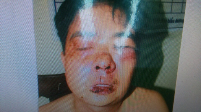 Anh Trần Đức Lợi bị những đối tượng tại nh&agrave; Th&agrave;nh Đốm h&agrave;nh hung khiến khu&ocirc;n mặt bị biến dạng nghi&ecirc;m trọng.