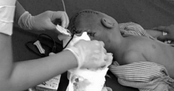 Gửi ở trường mầm non, cháu bé 3 tuổi bất ngờ bị chảy máu não