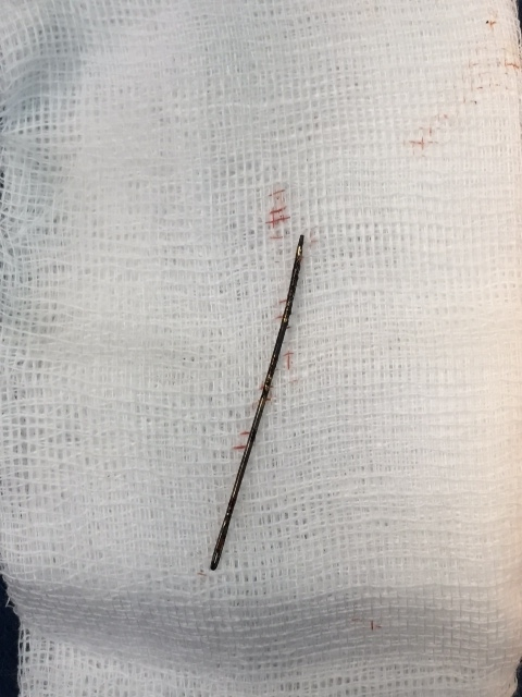 Chiếc kim kh&acirc;u d&agrave;i 4cm ở trong lồng ngực b&eacute; 3 tuổi suốt 2 năm. Ảnh: BVCC