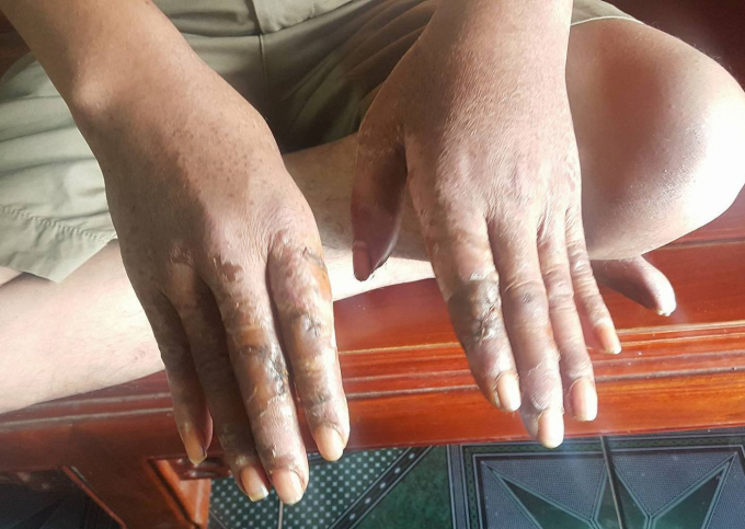 Những vết thương tr&ecirc;n tay anh Trung do nh&oacute;m đối tượng g&acirc;y ra.