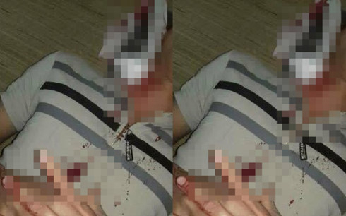 Nạn nh&acirc;n đang được điều trị tại Bệnh viện Qu&acirc;n y 105. (Ảnh: VOV)