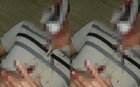 Hòa Bình: Đang điều tra vụ nghi vấn đạn lạc trúng cổ nam thanh niên