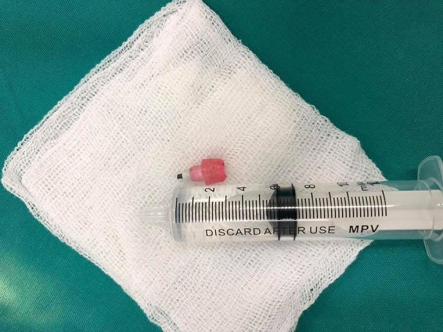 Dị vật đầu b&uacute;t ch&igrave; d&agrave;i 2cm được gắp ra từ phế quản của bệnh nhi 6 tuổi. Ảnh: BVCC